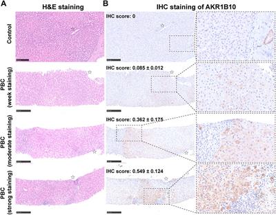 Identification of AKR1B10 as a key gene in primary biliary cholangitis by integrated bioinformatics analysis and experimental validation